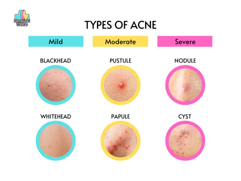 The 6 Types Of Acne How To Tell If Your Acne Is Mild Moderate Or Severe Howmedworks 