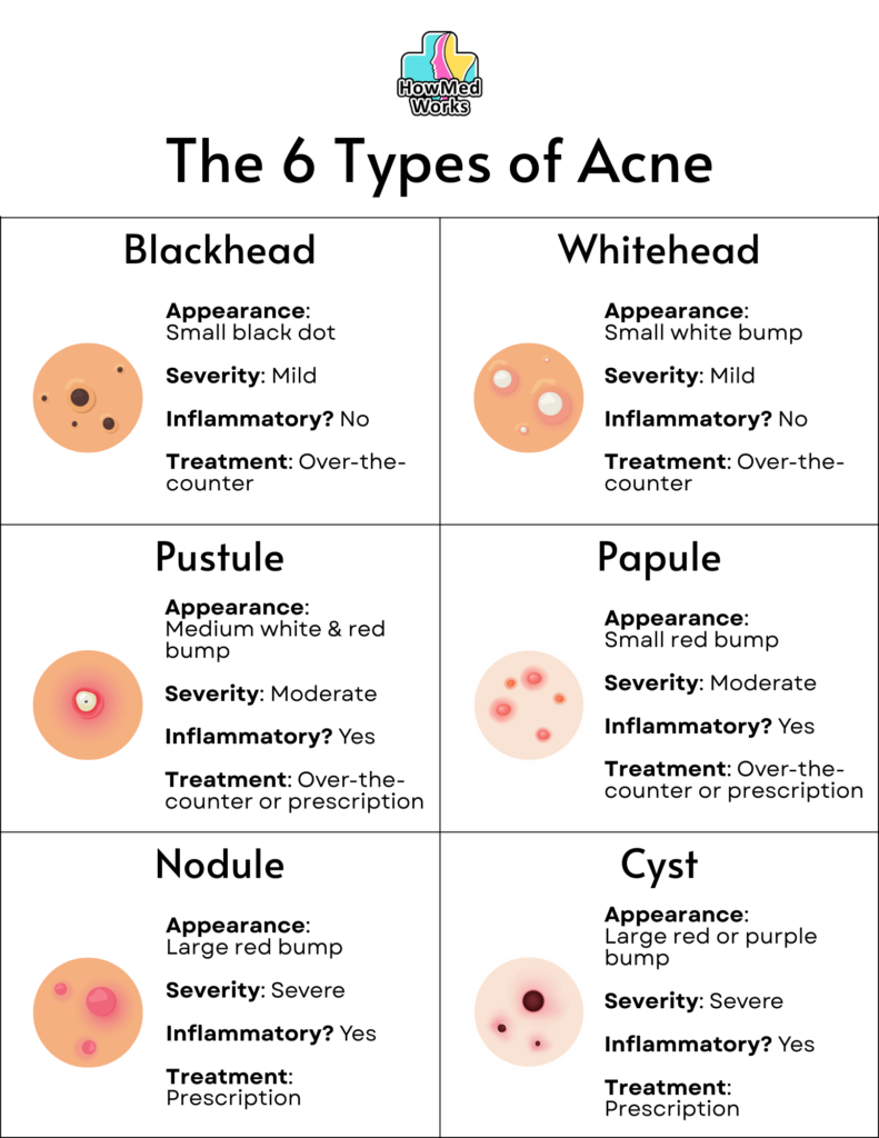 The 6 Types of Acne: How to Tell If Your Acne Is Mild, Moderate, or ...